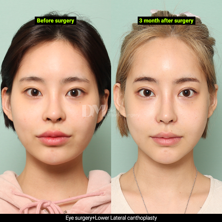 /images/en/Eyes_EyesSurgery/plastic surgery in korea_eyes surgeryBA04.jpg